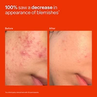 SOS Daily Hypochlorous Acid Spray for Breakouts & Redness