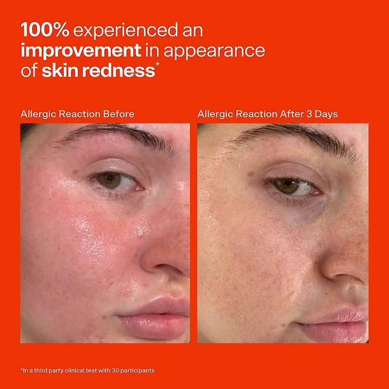 SOS Daily Hypochlorous Acid Spray for Breakouts & Redness