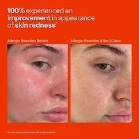 SOS Daily Hypochlorous Acid Spray for Breakouts & Redness