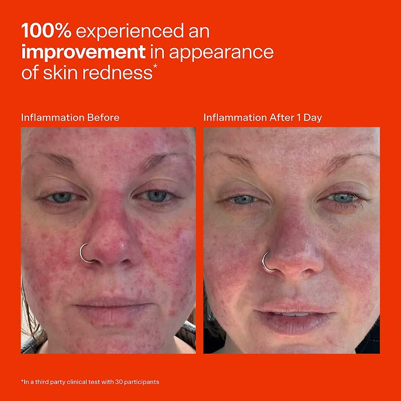 SOS Daily Hypochlorous Acid Spray for Breakouts & Redness