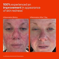 SOS Daily Hypochlorous Acid Spray for Breakouts & Redness