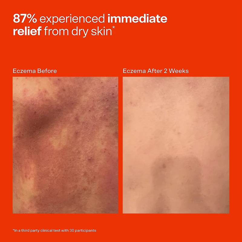 SOS Daily Hypochlorous Acid Spray for Breakouts & Redness