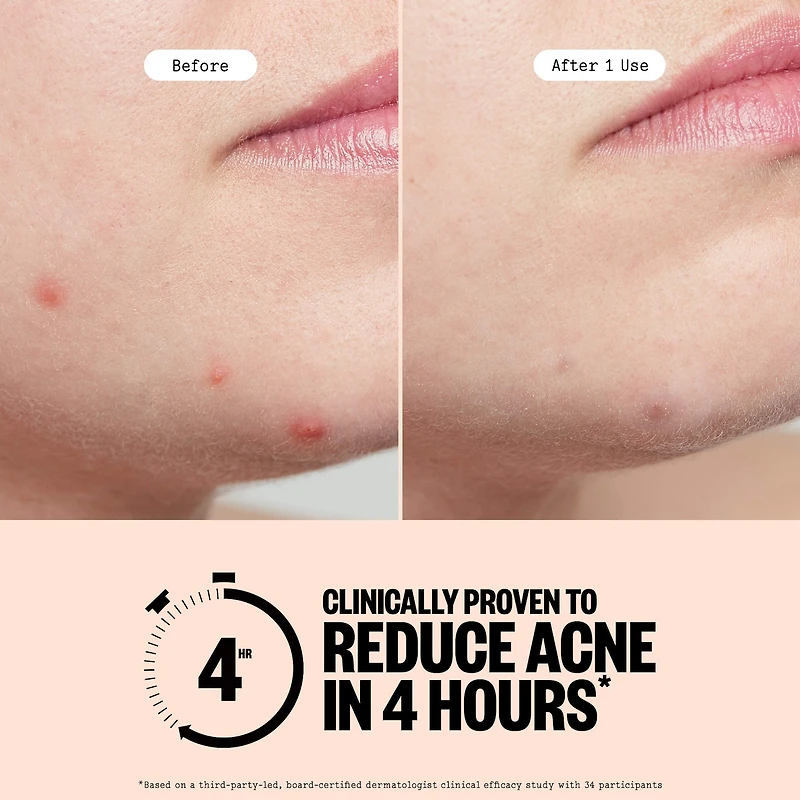 Salicylic Acid & Hydrocolloid Acne Treatment Pimple Patches