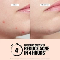 Salicylic Acid & Hydrocolloid Acne Treatment Pimple Patches