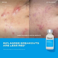 Deep Relief Acne Treatment with Salicylic Acid Liquid Pimple Patch for Painful Acne