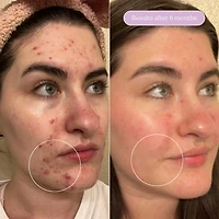 Huile pour peaux à tendance acnéique Meltdown