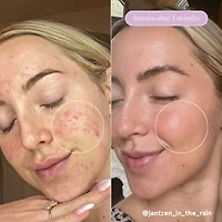 Huile pour peaux à tendance acnéique Meltdown