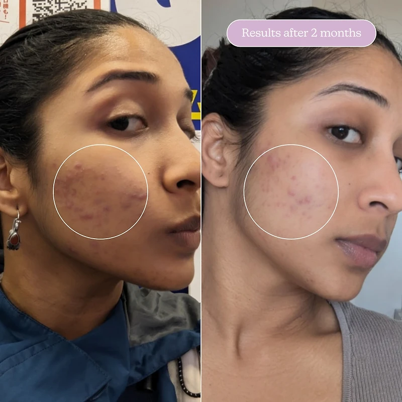 Sérum estompeur de cicatrice + taches pigmentaires Milky