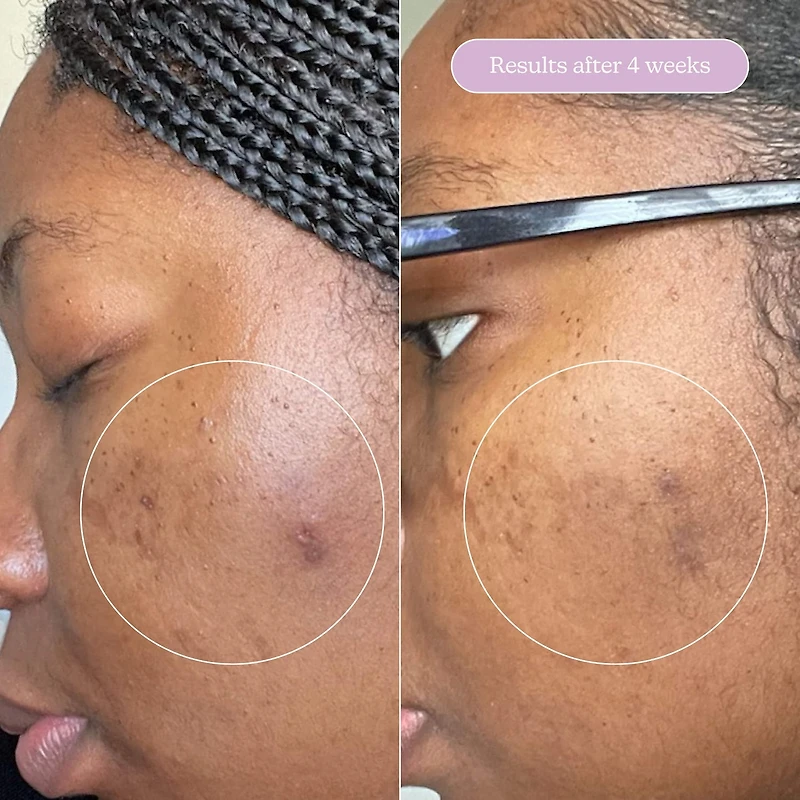 Sérum estompeur de cicatrice + taches pigmentaires Milky