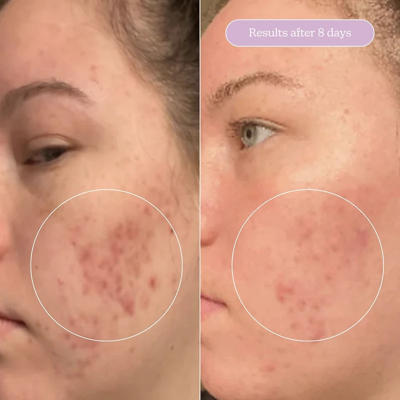 Sérum estompeur de cicatrice + taches pigmentaires Milky