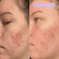 Sérum estompeur de cicatrice + taches pigmentaires Milky