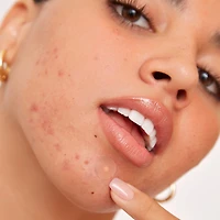 Peace Out Salicylic Acid Acne Healing Dots Mega Value Pack + Free Travel Bag