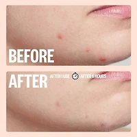 Salicylic Acid Acne Healing Dots