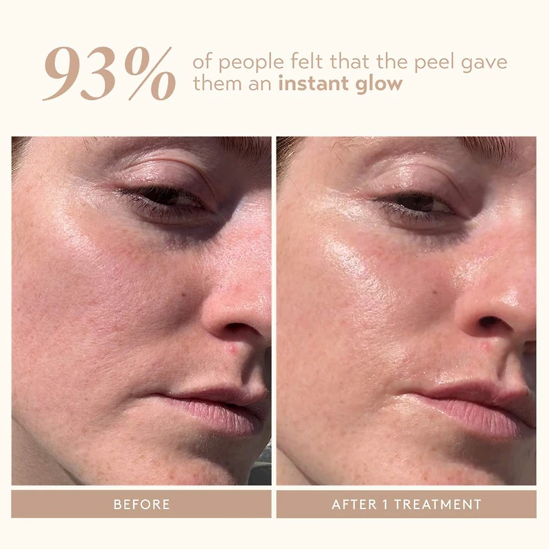 Triple Acid Signature Peel