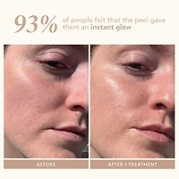 Triple Acid Signature Peel