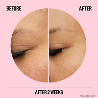 Microneedling Anti-Wrinkle Retinol Patches