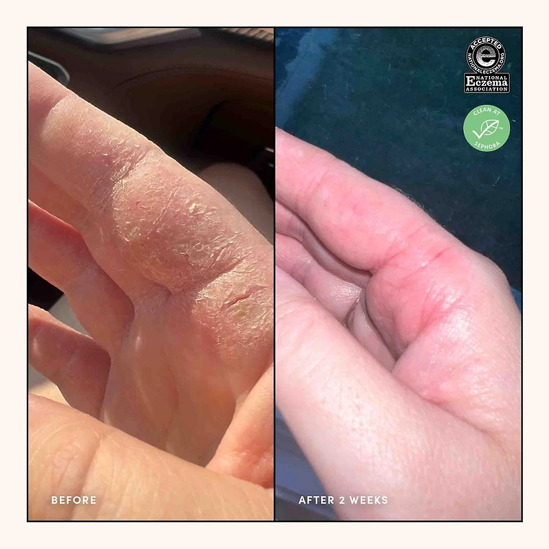 Eczema Relief Face and Body Treatment