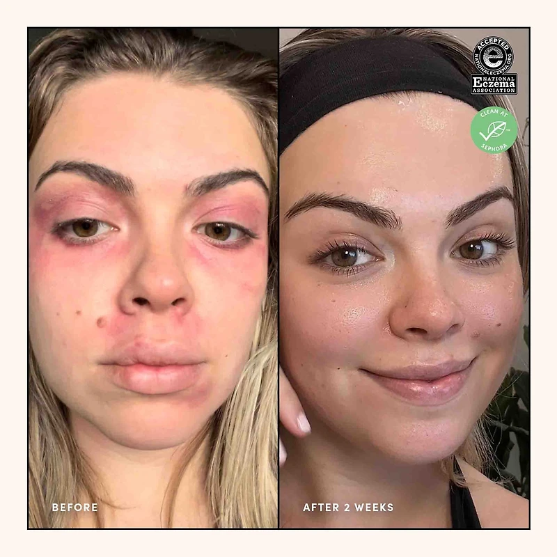 Eczema Relief Face and Body Treatment