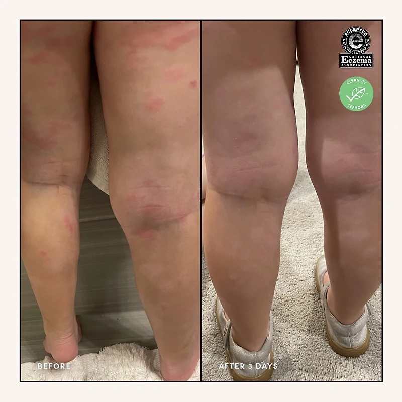 Eczema Relief Face and Body Treatment