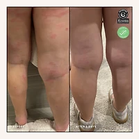 Eczema Relief Face and Body Treatment
