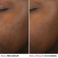 Soin pour peau acnéique à 2 % d’acide salicylique Bye Bye Breakout