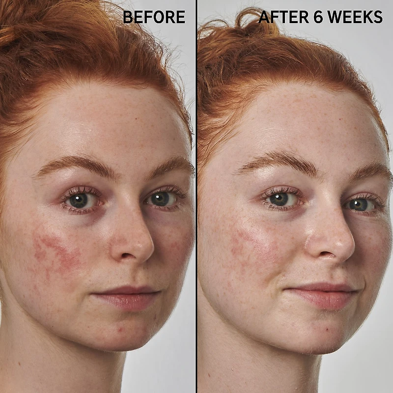 SuperSolutions 10% Azelaic Serum