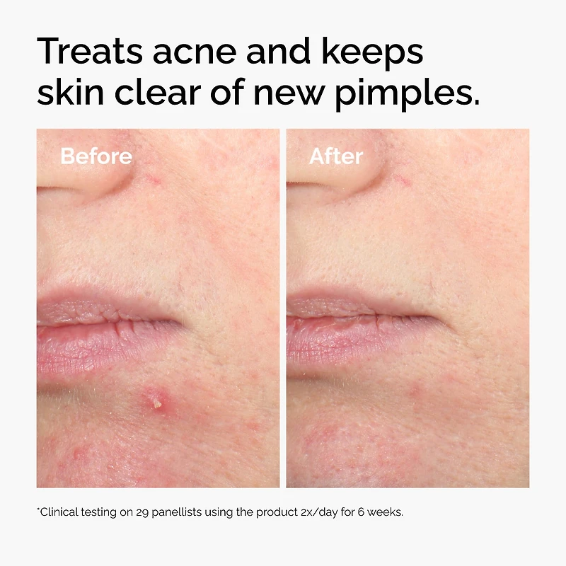 Solution exfoliante contre l’acné à 2 % d’acide salicylique