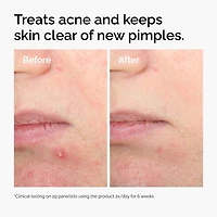 Solution exfoliante contre l’acné à 2 % d’acide salicylique