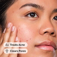 Solution exfoliante contre l’acné à 2 % d’acide salicylique