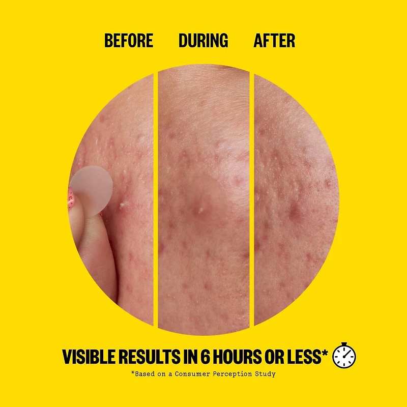 Salicylic Acid Acne Day Dots