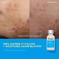 Soin anti-acné Deep relief avec acide salicylique