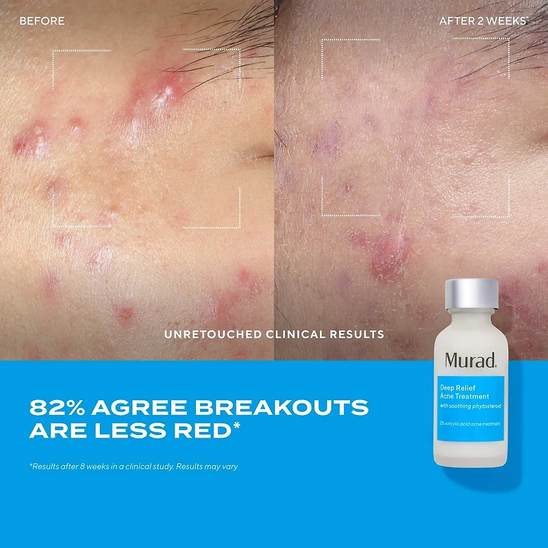 Soin anti-acné Deep relief avec acide salicylique