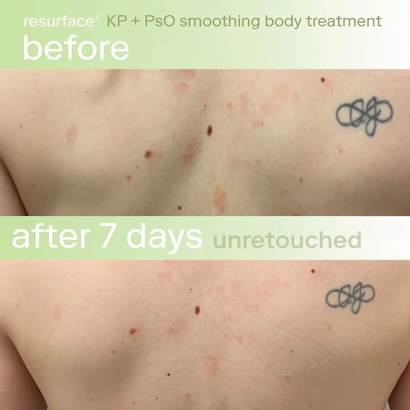 KP+ Psoriasis Smoothing Treatment Body Lotion