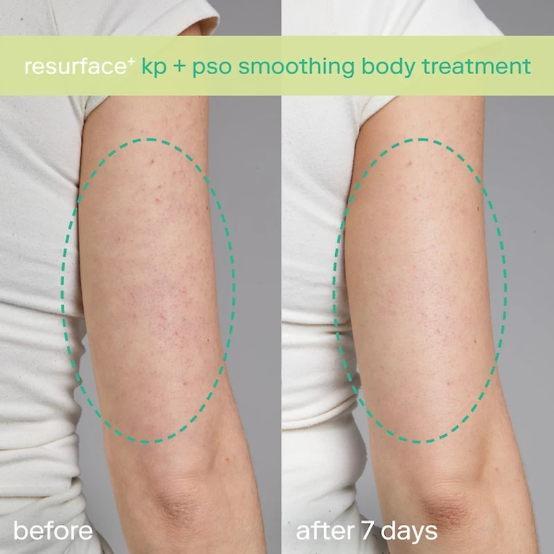 KP+ Psoriasis Smoothing Treatment Body Lotion