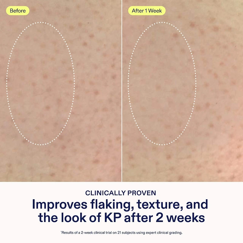 KP+ Psoriasis Smoothing Treatment Body Lotion