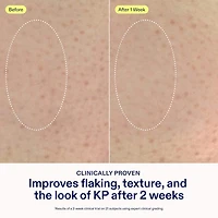 KP+ Psoriasis Smoothing Treatment Body Lotion