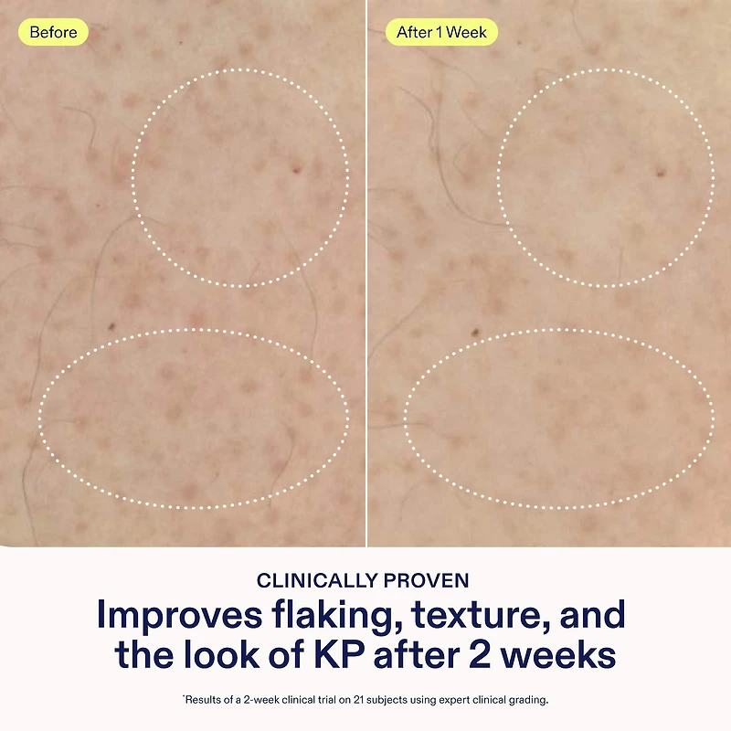 KP+ Psoriasis Smoothing Treatment Body Lotion