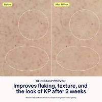 KP+ Psoriasis Smoothing Treatment Body Lotion
