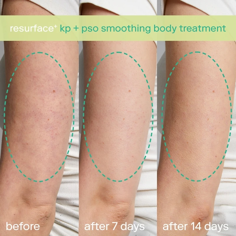 KP+ Psoriasis Smoothing Treatment Body Lotion