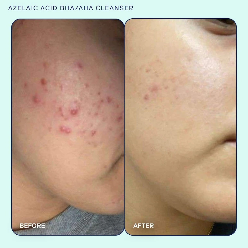 Azelaic Acid BHA/AHA Cleanser