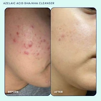 Azelaic Acid BHA/AHA Cleanser