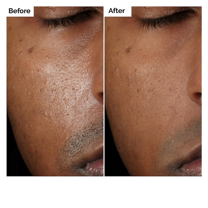 Solution à base de 2 % d’aloès et de 2 % de NAG