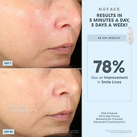 Trinity+® de NuFACE et un accessoire efficace pour les lèvres et les yeux