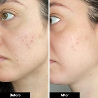 Pimple Paste