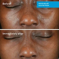 Rapid Relief Acne Sulfur Clay Mask with Salicylic Acid