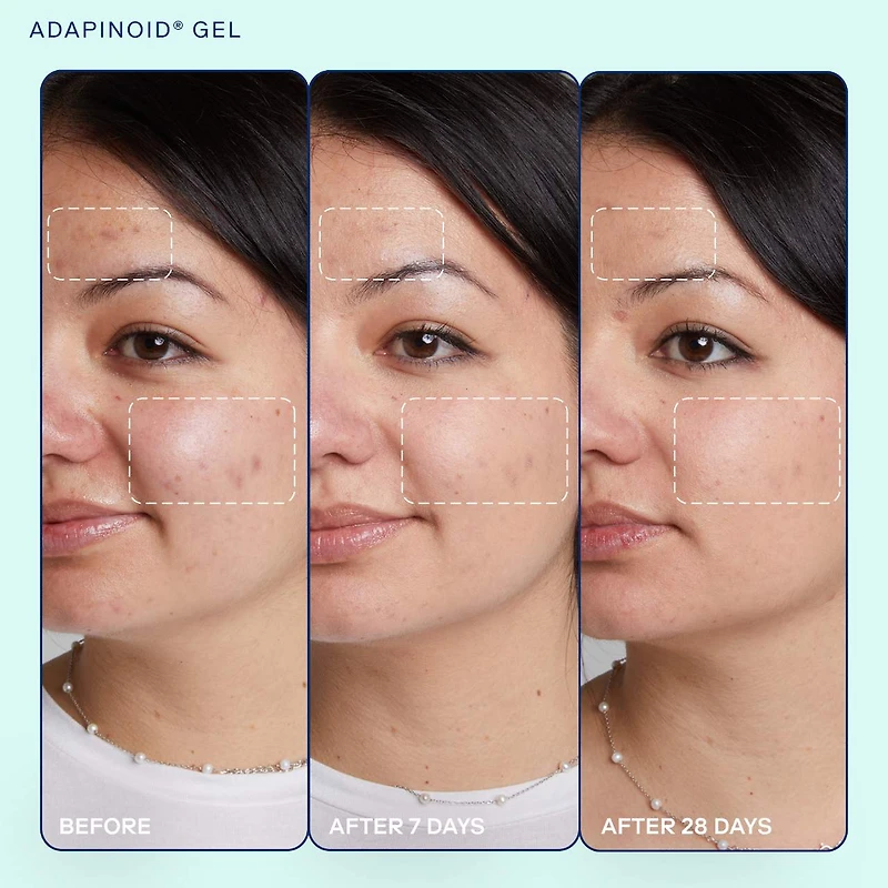 Gel à l’adapinoïde avec niacinamide et squalane acne+