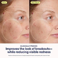 Gel à l’adapinoïde avec niacinamide et squalane acne+