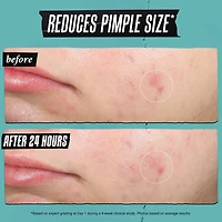 Truly Targeted Acne-Clearing Liquid Pimple Patch with Salicylic Acid