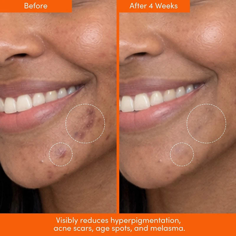 UNSPOTTED 4X Dark Spot + Hyperpigmentation AHA Serum