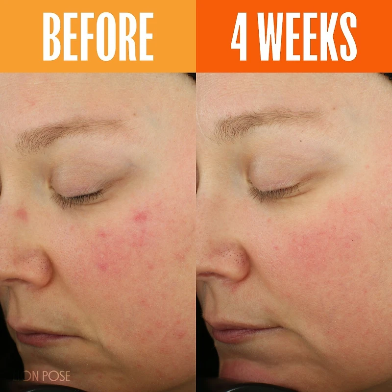 UNSPOTTED 4X Dark Spot + Hyperpigmentation AHA Serum